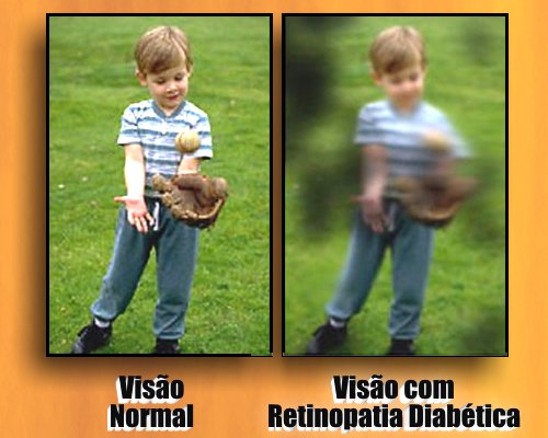 retinopatia diabetica material didatico