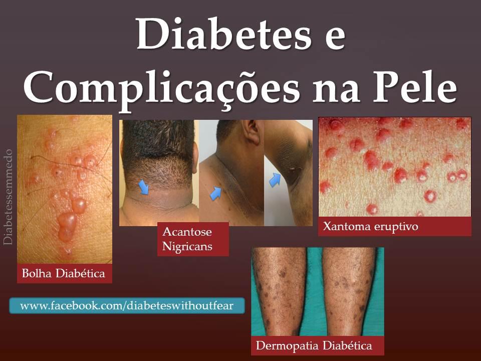 Diabetes e Complicações na Pele